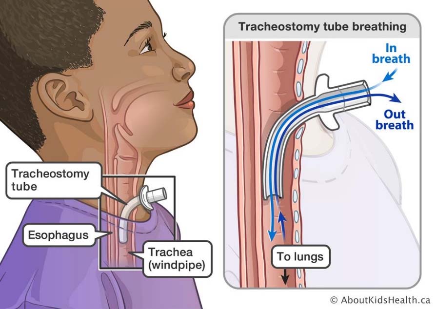 TrachTrak airflow analyzer project